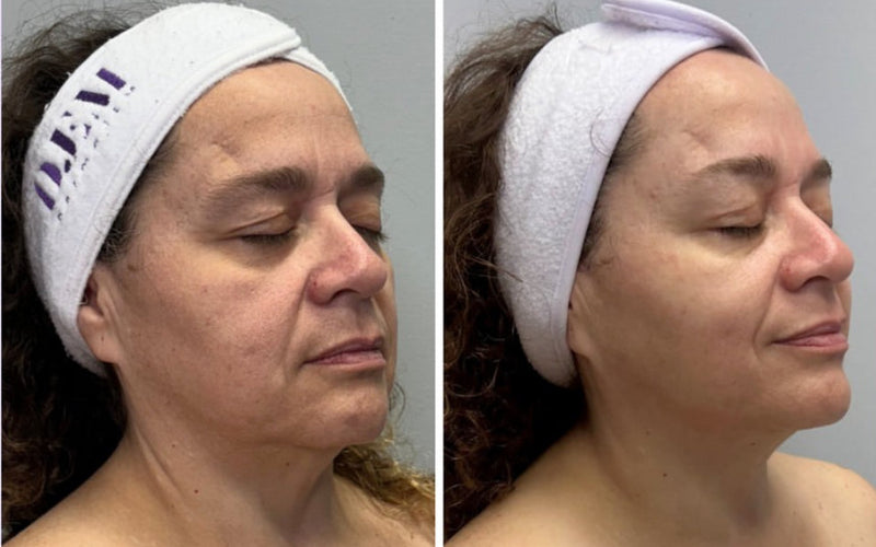 The Power of Microcurrent: Sculpt, Liff & Glow at Trin Spa