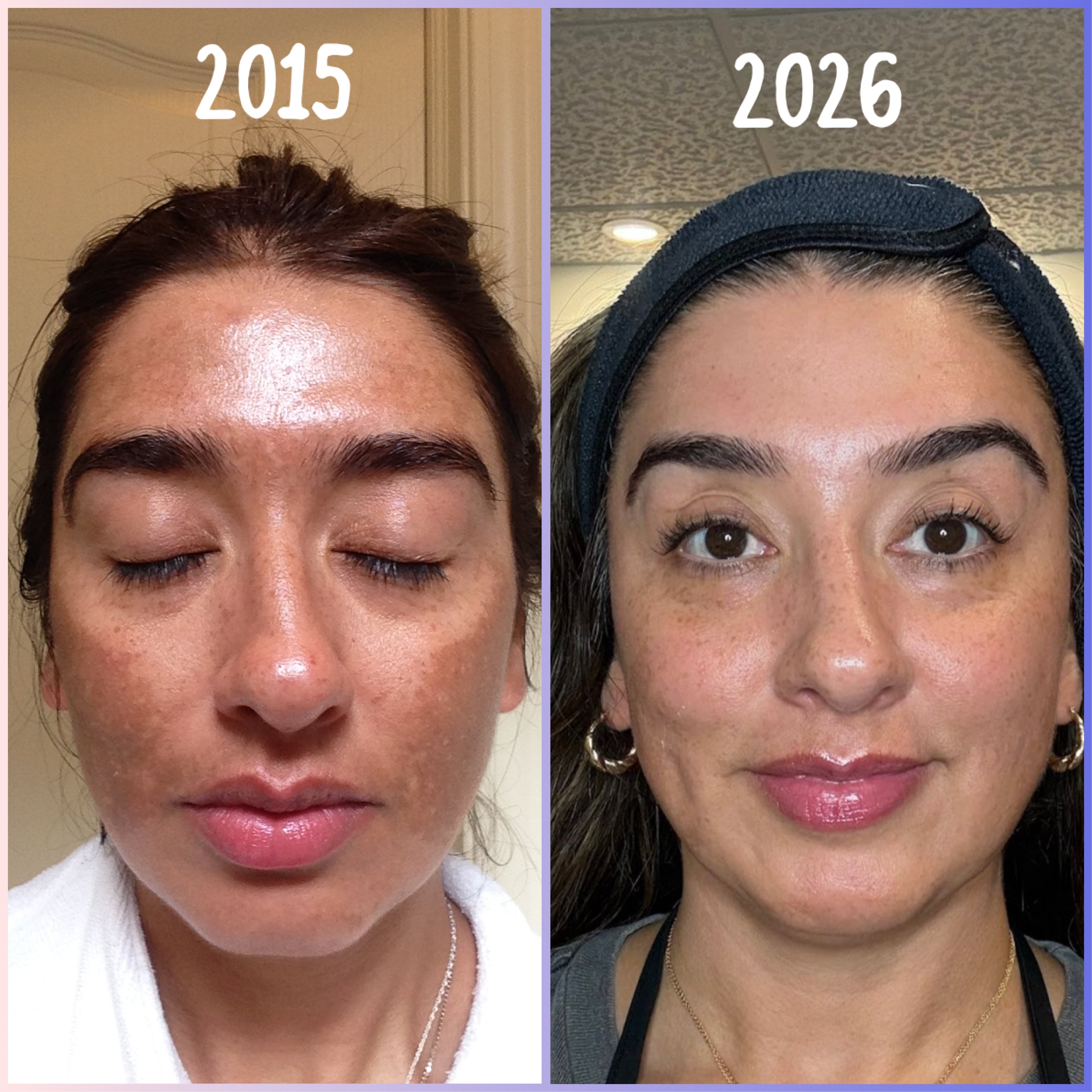 My Melasma Journey Since 2007