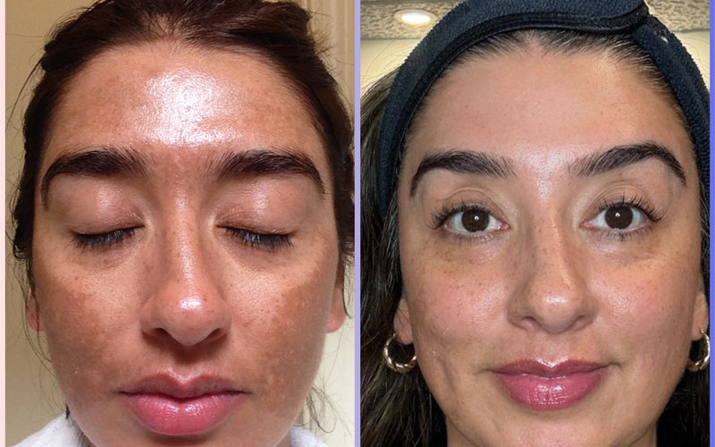 My Melasma Journey Since 2007